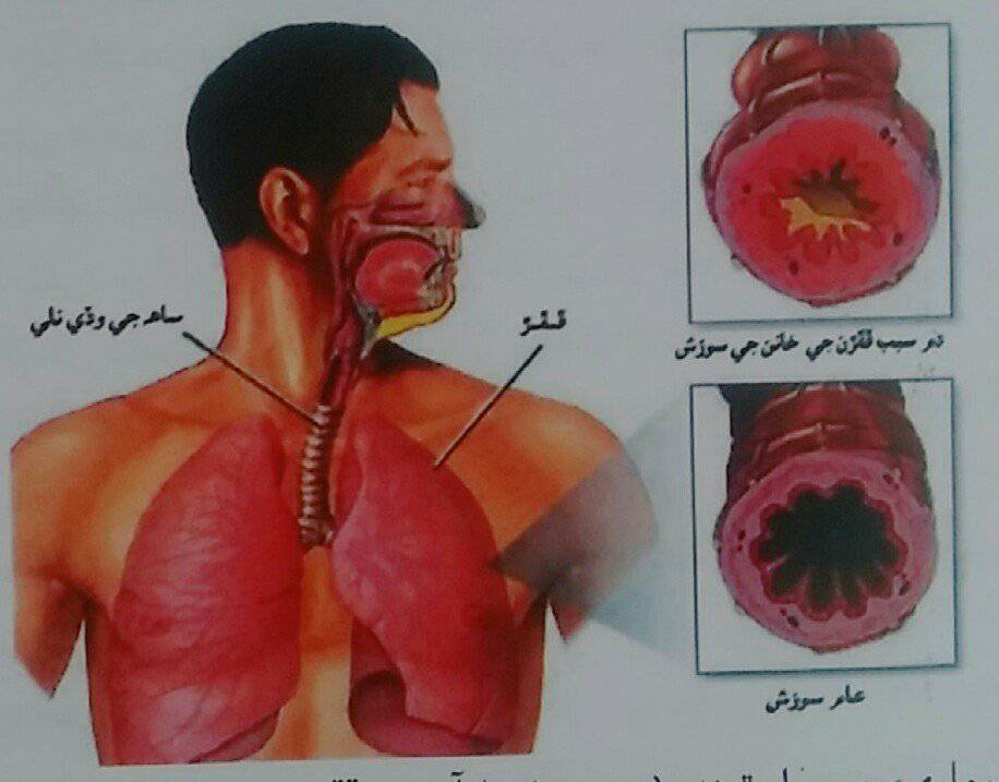 دم/ اُڀ ساهي- ساهه جي بيماري